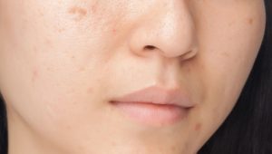 Nhân mụn nếu để lâu sẽ dễ để lại thâm, sẹo rỗ khó điều trị