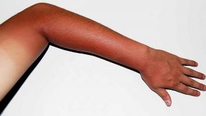 Da cháy nắng lâu ngày hoàn toàn có thể làm trắng được