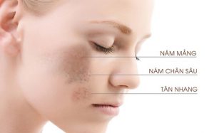 Làn da của mẹ bầu xuống cấp trầm trọng sau khi sinh