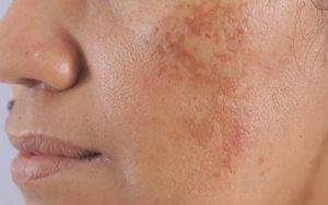 Nám gây mất thẩm mỹ cho da mặt