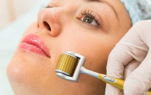 Lăn kim tạo nên các vết thương hở li ti trên bề mặt da