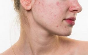 Da mặt trong thời gian mang thai thường gặp nhiều vấn đề, nên cũng cần phải chăm sóc chị em nhé.