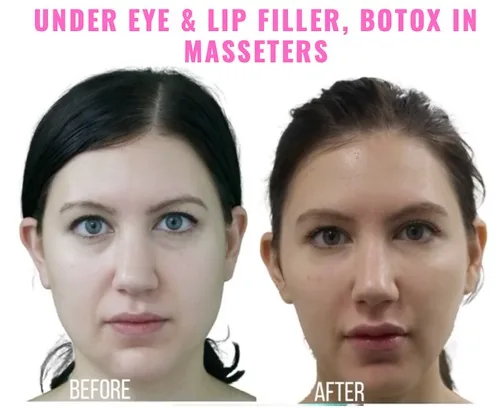 Filler Botox training course beginner