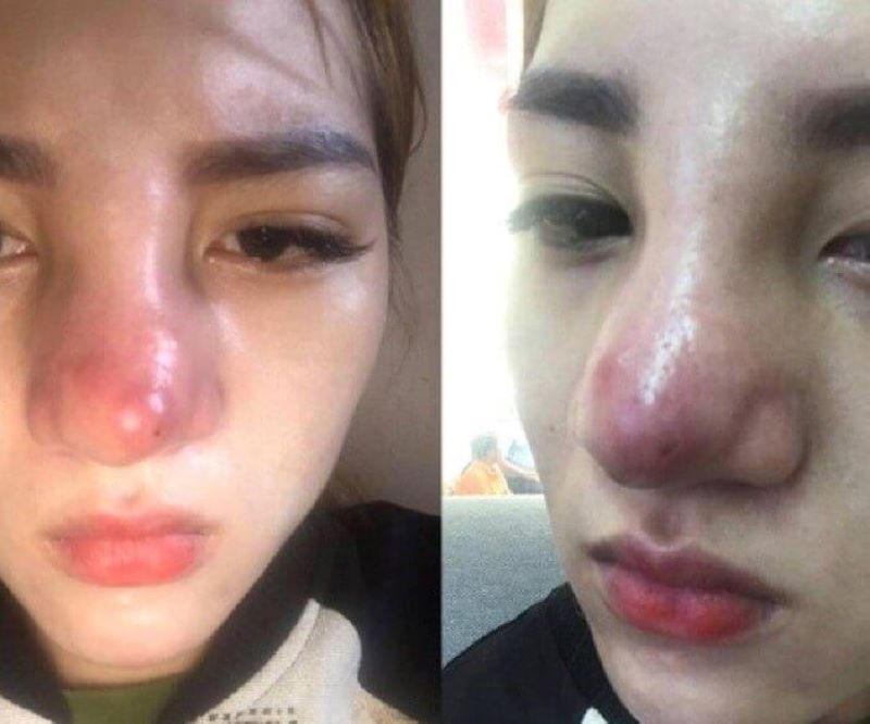 Khi thực hiện tiêm tan filler mũi của bạn có thể bị sưng
