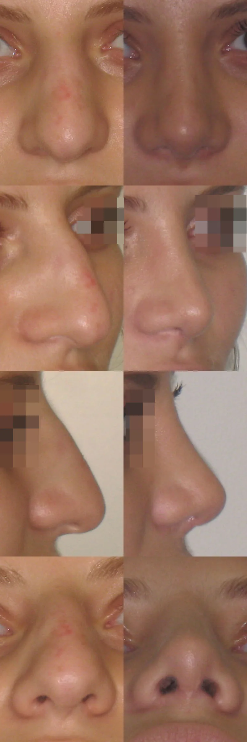 An toàn và chống chỉ định nâng mũi Asform