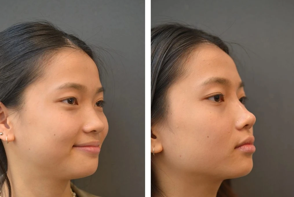 Cần nắm rõ thời gian sụn mũi hết tuổi thọ để có phương pháp thay thế phù hợp