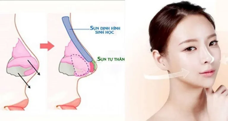 Nâng mũi sụn tự thân là gì và hình minh họa sử dụng sụn tự thân trong nâng mũi.