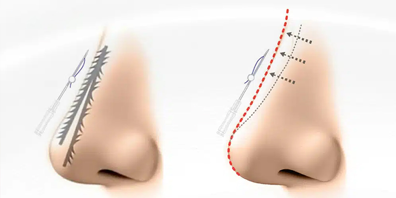 Nâng mũi chỉ có độ xâm lấn khá thấp so với các phương pháp truyền thống khác