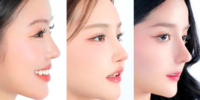 Nâng mũi sụn tự thân giá bao nhiêu vào năm 2026?