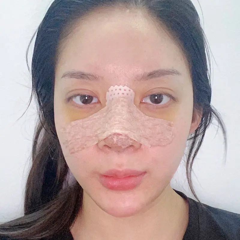 Tình trạng bầm tím sau nâng mũi sẽ giảm dần sau 10 ngày đầu