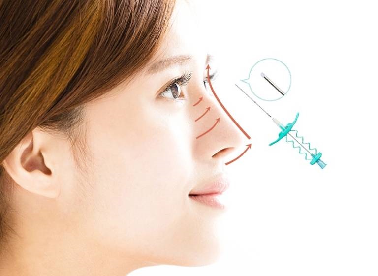 Dù an toàn những nâng mũi chỉ vẫn có thể tồn đọng một số rủi ro nhất định