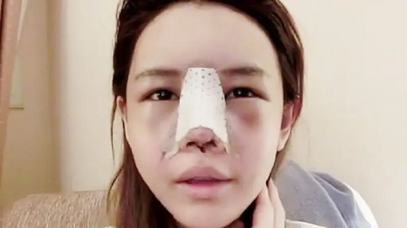 Nắm rõ quá trình hồi phục sau nâng mũi giúp chị em biết cách chăm sóc và ăn uống phù hợp