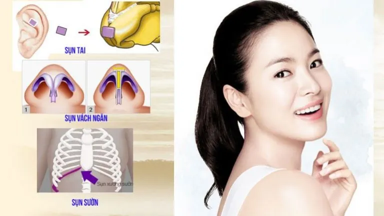 Nâng mũi 3D kết hợp sụn tự thân với sụn tai, sụn vách ngăn và sụn sườn.