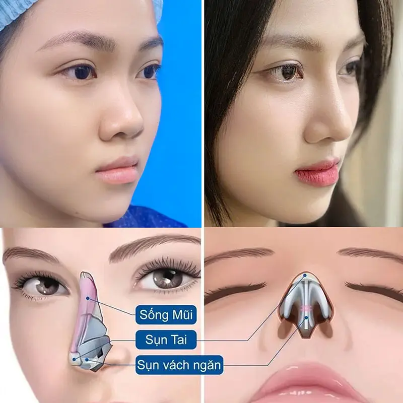 Kết quả nâng mũi thường duy trì lâu dài, phụ thuộc nhiều vào cách chăm sóc