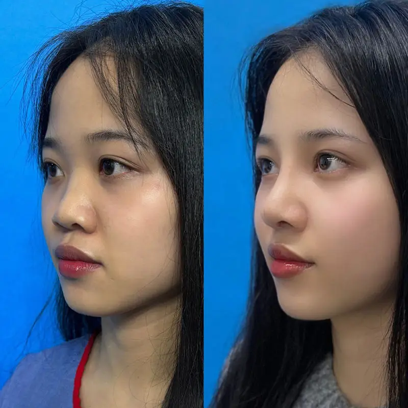 Vì sao mũi còn sưng sau 2 tháng nâng mũi và hình ảnh minh họa quá trình hồi phục.