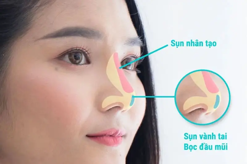 phương pháp nâng mũi bọc sụn vành tai, cho thấy vị trí sụn nhân tạo trên sống mũi và sụn vành tai được sử dụng để bọc, bảo vệ đầu mũi.