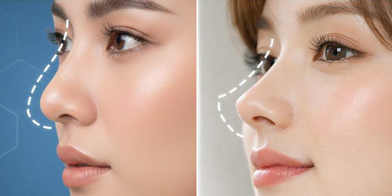 Thời gian thực hiện và hồi phục của 2 phương pháp nâng mũi thường và cấu trúc là khác nhau