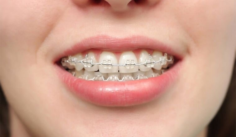 Sau nâng mũi sẽ khó để đeo niềng răng