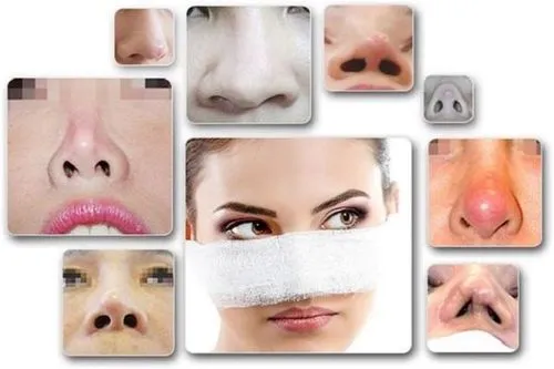 các biến chứng có thể ảnh hưởng đến độ bền của dáng mũi sau nâng mũi bọc sụn tai, đồng thời cung cấp thông tin về quá trình hồi phục, hiện tượng bao xơ và sự thay đổi của sụn theo thời gian.