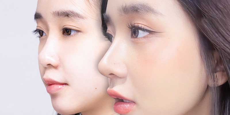 Nâng mũi asform khá an toàn nhưng vẫn tồn tại một số rủi ro nhất định