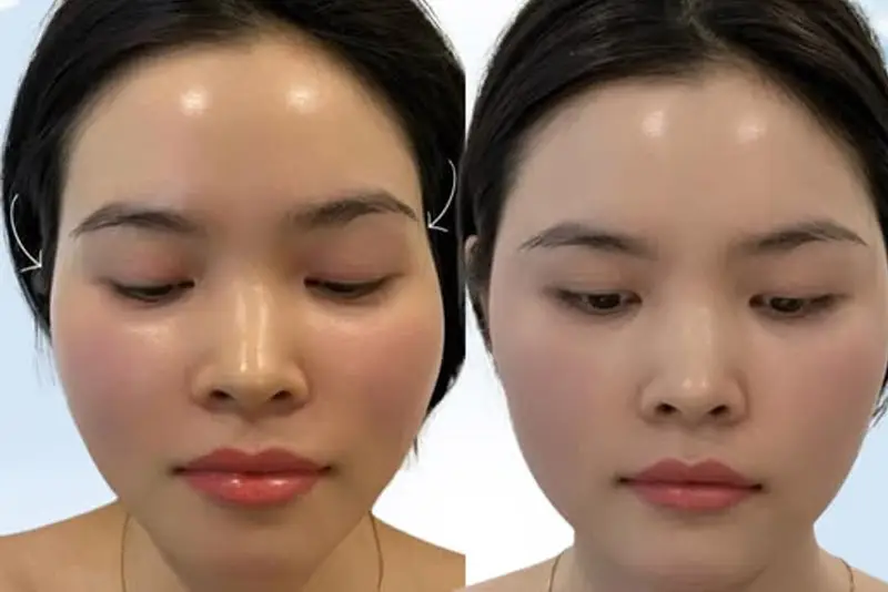 thay đổi vùng mũi và khuôn mặt trước và sau khi tiêm filler, phù hợp với nội dung về chăm sóc sau tiêm và thời gian duy trì hiệu quả của filler mũi.
