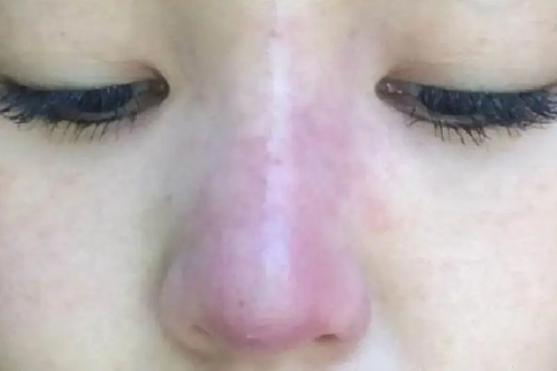 tình trạng mũi bị sưng đỏ sau khi tiêm filler, thường được đề cập khi nói về các rủi ro và biến chứng có thể xảy ra.