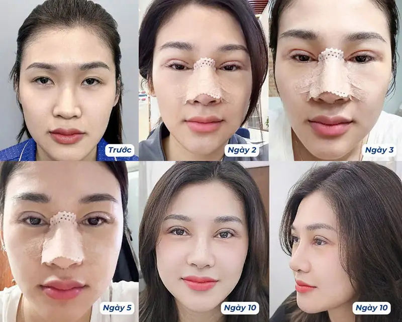 Các giai đoạn sưng mũi khác nhau sau phẫu thuật từ ngày 2 đến ngày 10.