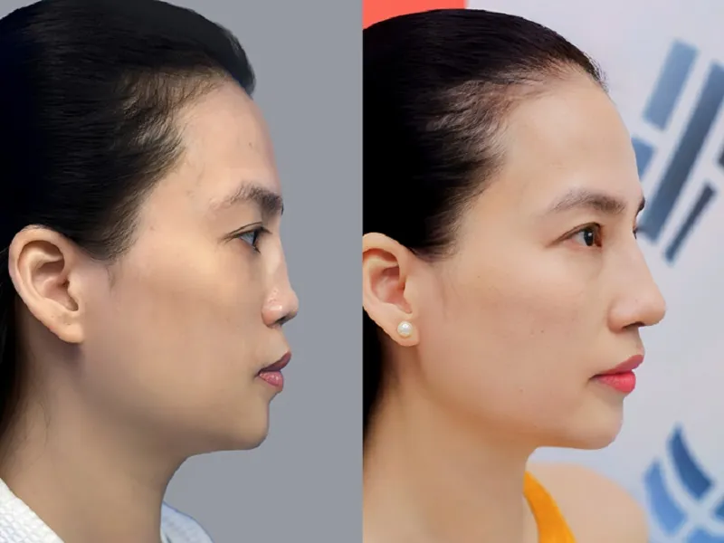 kết quả trước và sau nâng mũi, cho thấy sự thay đổi dáng mũi khi nhìn nghiêng sau phẫu thuật.