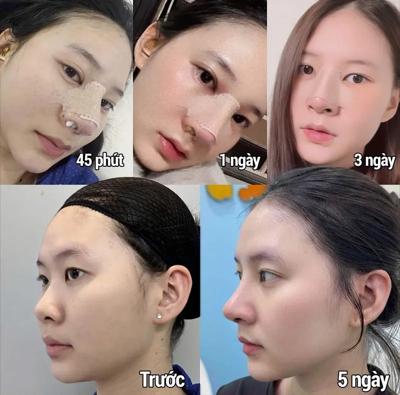 quá trình lành vết mổ sau nâng mũi qua các mốc 45 phút, 1 ngày, 3 ngày và 5 ngày.