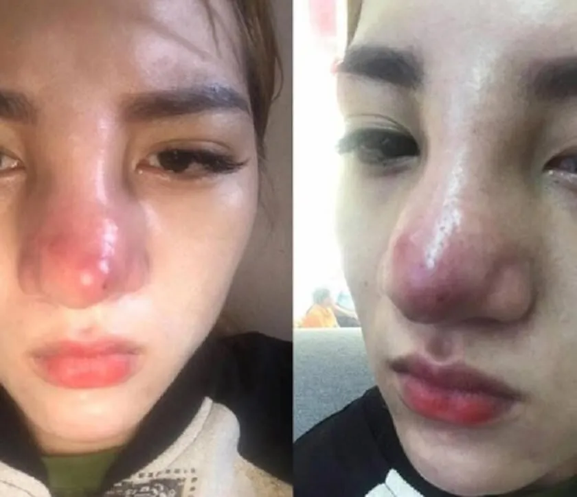 biến chứng sau nâng mũi với tình trạng vùng mũi sưng đỏ, bầm tím và có dấu hiệu bất thường trong giai đoạn hậu phẫu.