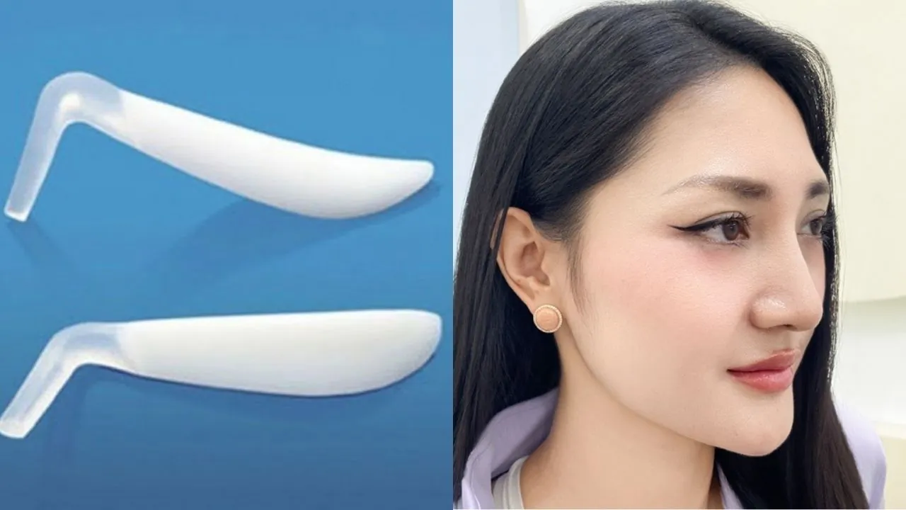 vật liệu nâng mũi và dáng mũi sau phẫu thuật, thể hiện sự khác biệt giữa sụn nhân tạo và kết quả nâng mũi