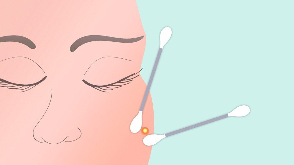 Nặn mụn khiến tình trạng da xấu đi