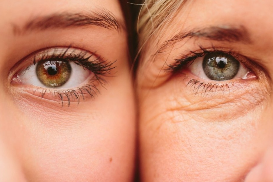  Mắt sau khi giảm bọng mắt