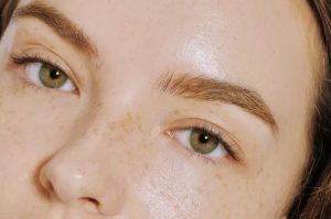 Nám da là vấn đề phổ biến thường xuất hiện sau độ tuổi 30