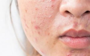 Có rất nhiều nguyên nhân gây ra tình trạng da mụn