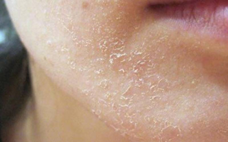 Có thể xảy ra một số tình trạng bong tróc nhưng bạn đừng lo lắng nhé
