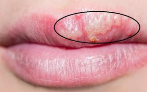 Nên kiêng cữ một số thực phẩm để không bị ảnh hưởng xấu