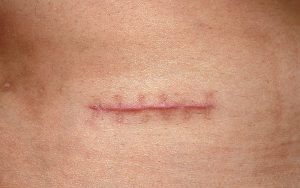 Rau muống gây nên sẹo lồi cho những vết thương hở