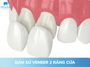 Dán sứ veneer 2 răng cửa
