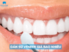 Dán răng sứ Veneer giá bao nhiêu? Bảng giá dán Veneer 2026