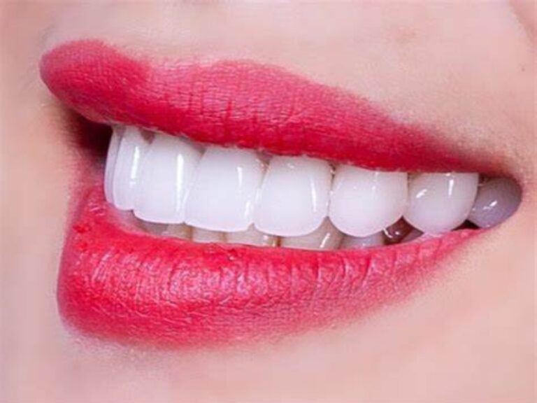 How much does porcelain veneer cost? Detailed price list 2024