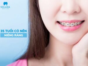 35 tuổi có nên niềng răng