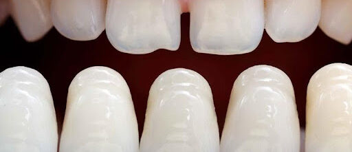 Răng sứ Zirconia và Cercon loại nào tốt hơn? 6 Răng sứ Zirconia có tính thẩm mỹ cao