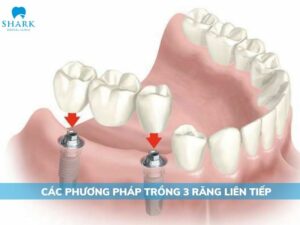 trồng 3 răng liên tiếp
