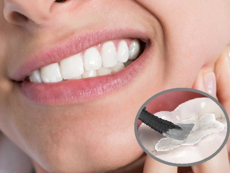 Thời gian trám răng mất bao lâu để hoàn thành? 10 Số lượng răng trám là yếu tố quyết định thời gian trám răng diễn ra bao lâu