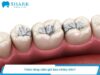 Trám răng cấm bị sâu bao nhiêu tiền? Giá trám răng cấm 9/2026