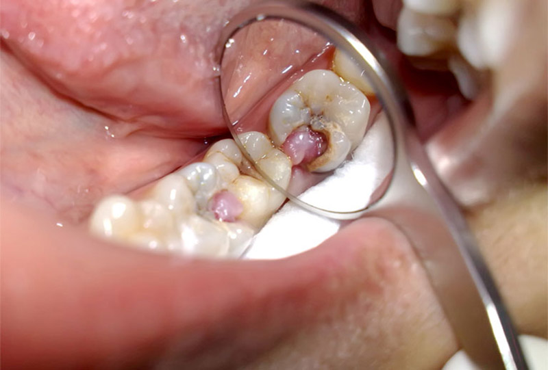 Răng Sâu Nhiều Có Trám Được Không? Phân Tích Từ Góc Nhìn Nha Khoa Chuyên Môn 4 Tại sao không nên tự ý quyết định?