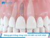 Trồng răng cửa Implant giá bao nhiêu tiền? Chi tiết giá 2026