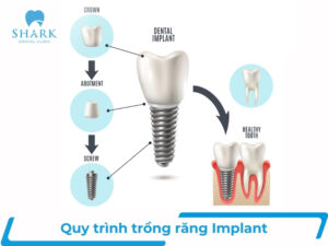 6 bước trong quy trình trồng răng Implant tiêu chuẩn nhất