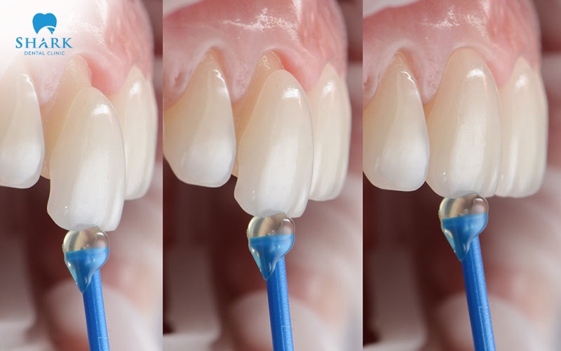 Keo dán răng giả nên được mua tại nha khoa uy tín và được thực hiện dán bằng bác sĩ có chuyên môn